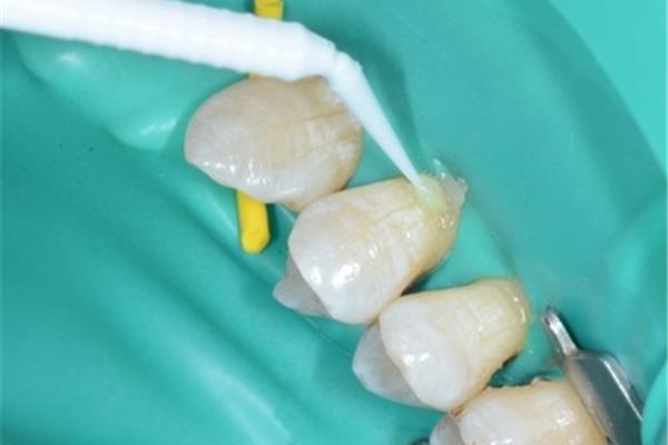 復雜填充補牙能管多久
