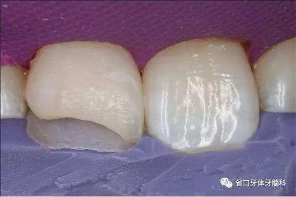 牙齒光固化能保持多久