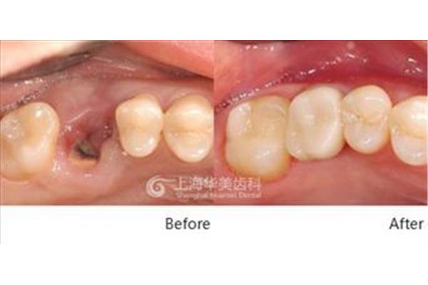 拔完牙多久可以修復?一般拔牙幾個月后就可以補牙了