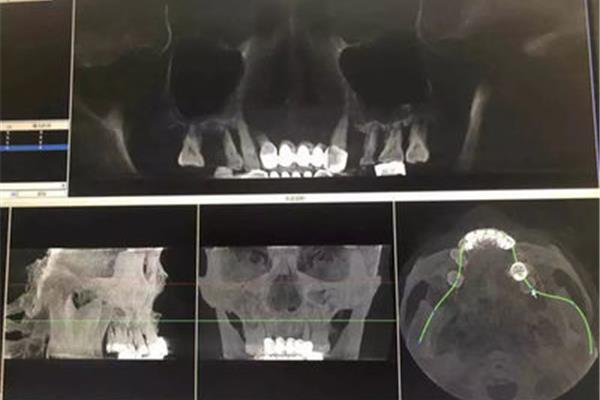 植骨多久能刷到手術區,植牙會很痛嗎,需要多久?