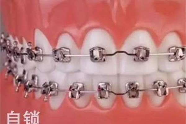 牙齒矯正最快需要多久?哪些牙套矯正牙齒效果比較好?