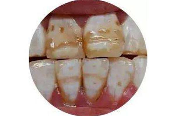 四環素牙多久可以形成?矯正牙齒需要多少錢?