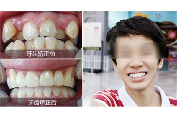 牙齒矯正一般需要多久,正畸矯治器需要多久?
