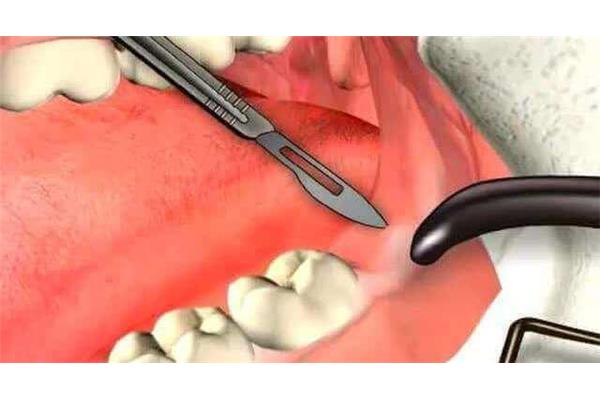 拔牙后出血多長時間能恢復,拔牙后多久能正常?