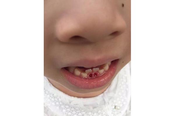 乳牙拔掉后能吃多久,孩子乳牙拔掉后能正常吃多久?
