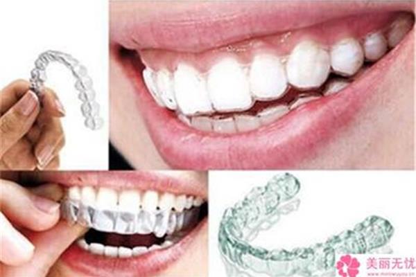 門牙有裂縫需要多久矯正,成年人矯正牙齒需要多久?
