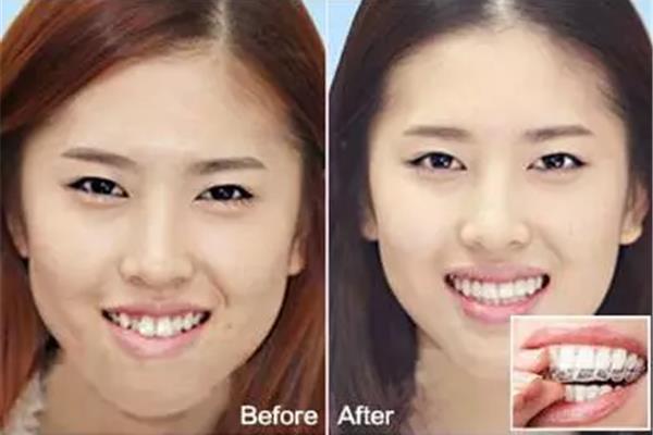 牙齒矯正后多久臉會變,矯正后多久會反彈?