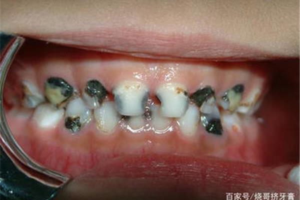門牙蛀牙補牙多久時間