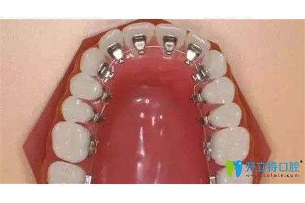 隱形牙套矯正多久,矯正牙齒戴牙套多久?