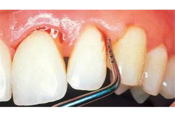 引流后可以開髓嗎?關于牙髓炎治療的幾個問題