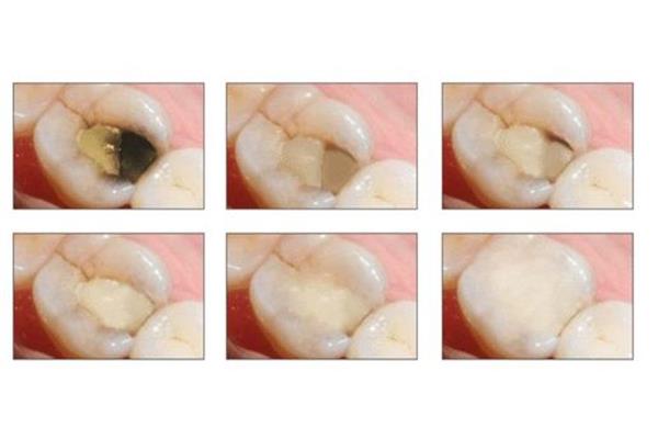 樹脂補牙可以用多久,鉆孔后補牙需要多久?