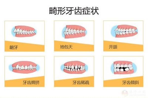 牙套的作用牙套應該戴多久,牙套一般應該戴多久?