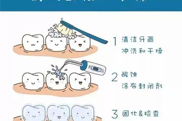 窩溝封閉后多久可以刷牙?窩溝封閉有害嗎?