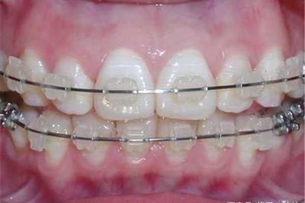拔牙戴牙套需要多長時間,拔牙戴牙套后多久可以閉合?