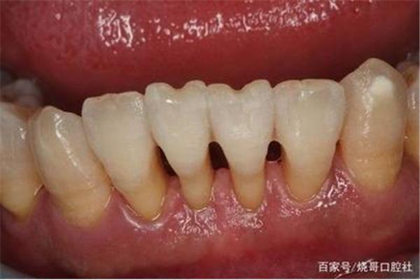 刮牙齦多久能恢復,洗牙牙齦多久能恢復?