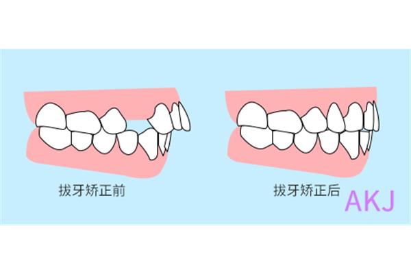 拔牙時造成的血腫需要多久才能消除,正畸拔牙的在哪里?