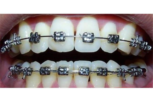 牙齒矯治器托槽總是脫落的原因是什么?