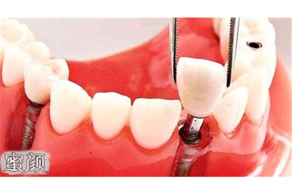 牙齒出血拔完多久能恢復,牙齒出血拔多長時間是正常的