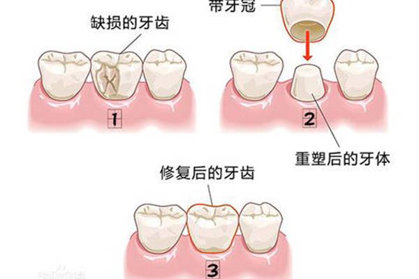 牙齒外傷后需要多久做根管治療,牙齒需要多久做根管治療?