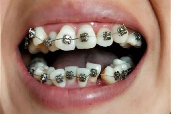 牙齒矯正需要多久才能得到一個支抗,牙齒矯正什么時候得到一個支抗?