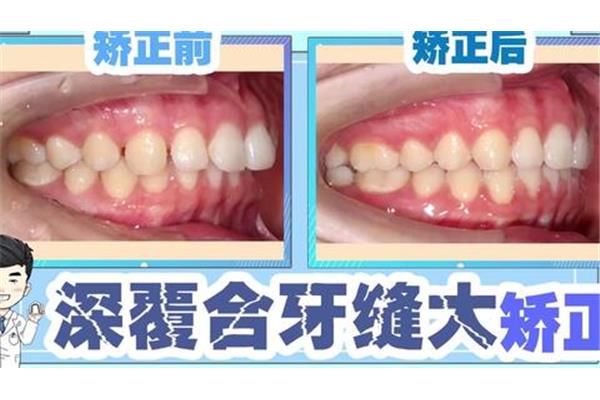 磨牙墊矯正多久可以去掉,磨牙矯正對牙齒的傷害有多大?