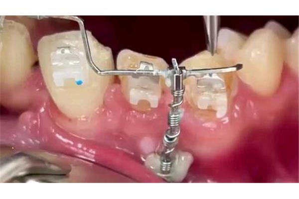 恒牙牽引手術需要多長時間?恒牙牽引一定要戴牙套嗎?