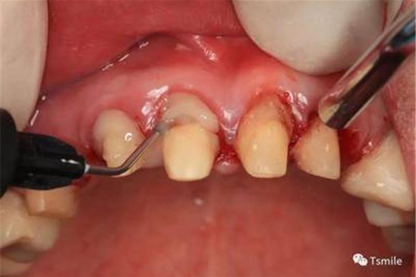 如何制作臨時牙冠?制作臨時牙冠后疼痛的原因是什么?