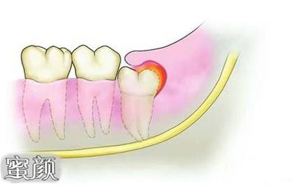 拔牙后多長時間會出血,拔牙多長時間出血是正常的