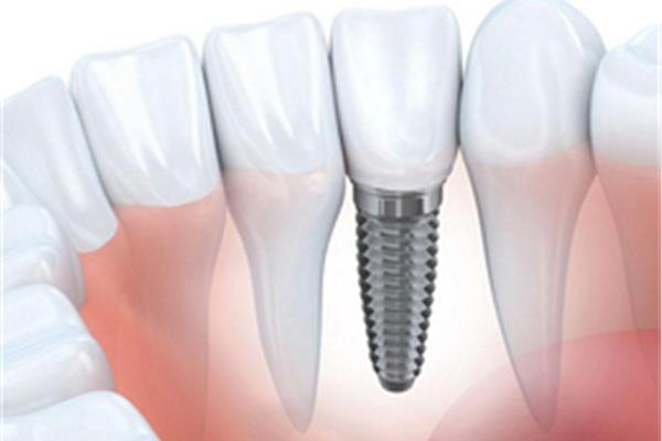 植入一顆人工牙根需要多久,植入一顆人工牙根需要多久?