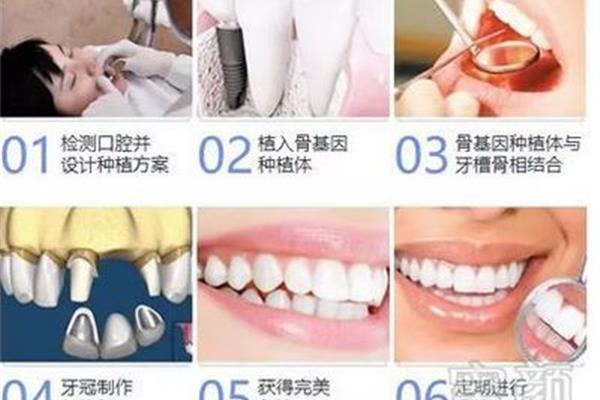 拔牙后多久種牙,拔牙后多久種牙?