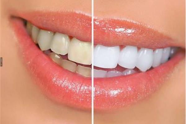 懷孕用冷光可以美白牙齒多久,牙齒可以美白多少,可以美白多久?