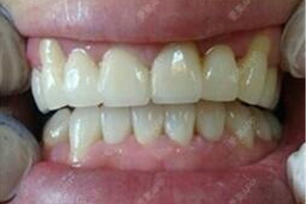 帶牙套后多久可以洗牙,剛帶牙套多久會反彈?