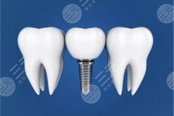種植牙、植骨后需要多長時間恢復,種植牙、植骨需要多長時間恢復?