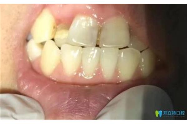 檢查補體需要多長時間才能出結果,種植牙用什么材料最好?
