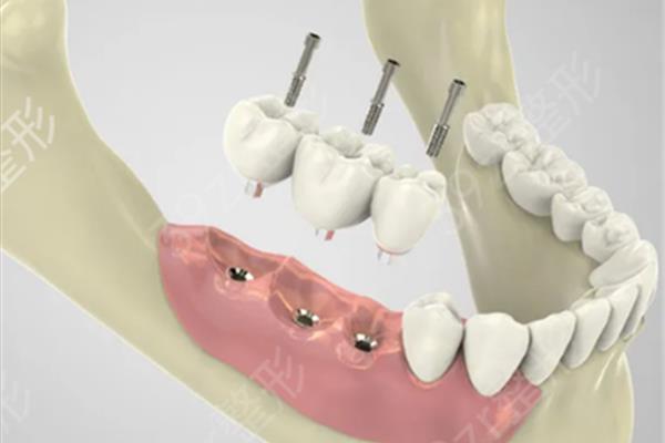 種植牙多少天可以消腫?如何減輕種植牙的腫脹?