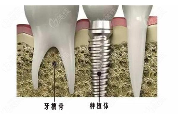 植骨后多久可以做種植牙手術,做種植牙需要多長時間?