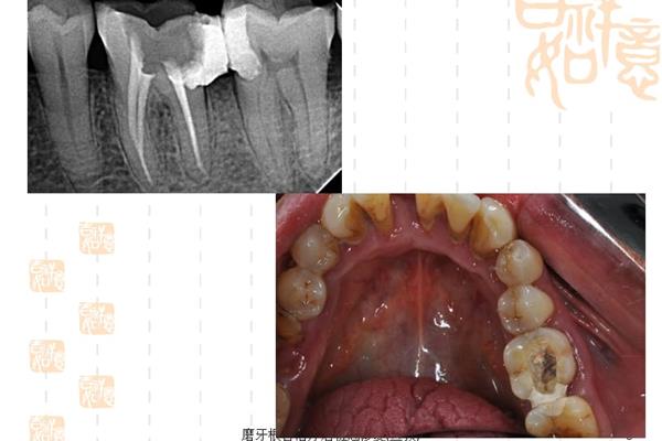 根管治療和牙齒打樁,請解釋牙齒的樁冠修復