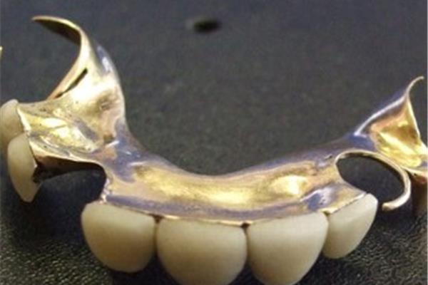固定假牙可以用多久?一般假牙的使用壽命是多久?