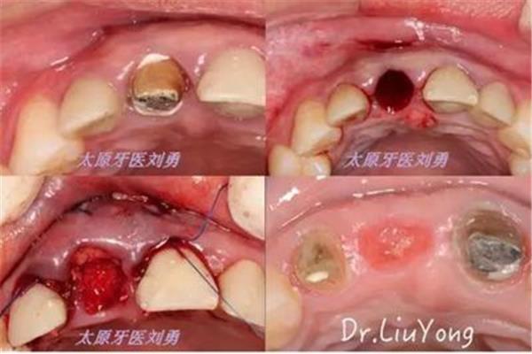 膜状牙龈手术多久恢复(怎么做膜状牙龈手术)