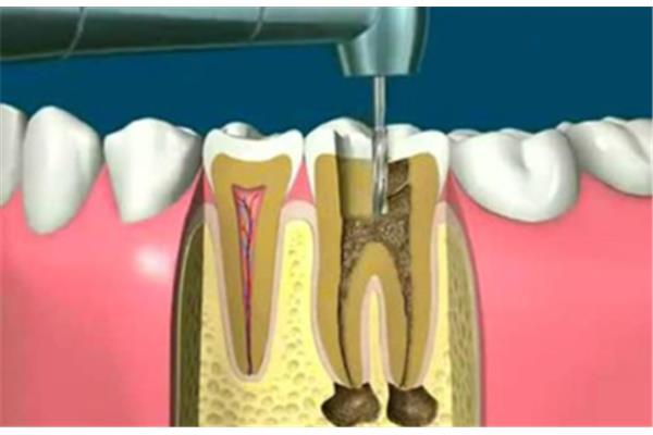 根管治疗需要多长时间(补牙和疏通根管)