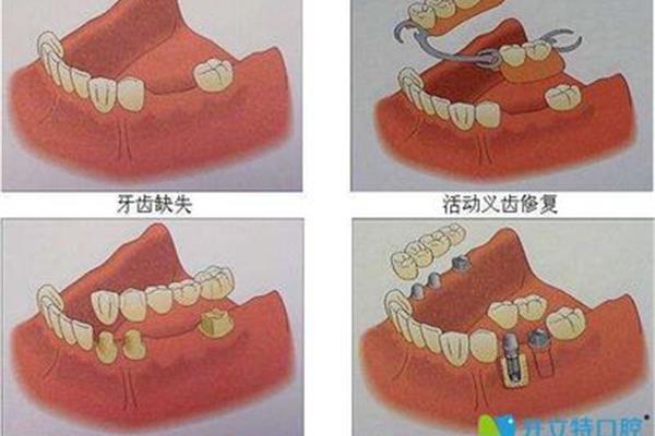 成年人的牙齒能插多長時間長出來?