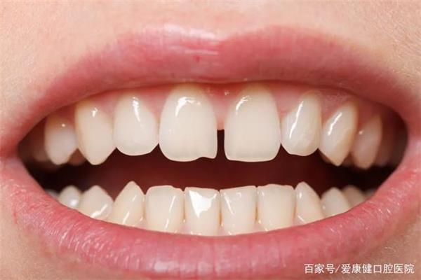 磨牙后多久戴全瓷牙(带全瓷牙的前磨牙多久会疼?)