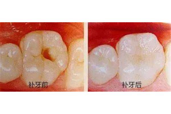 根管治療后牙疼怎么辦,補牙后牙疼怎么辦?