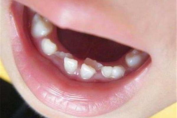 一歲多的寶寶牙齦炎多久會好,一周半的寶寶牙齦炎多久會好?