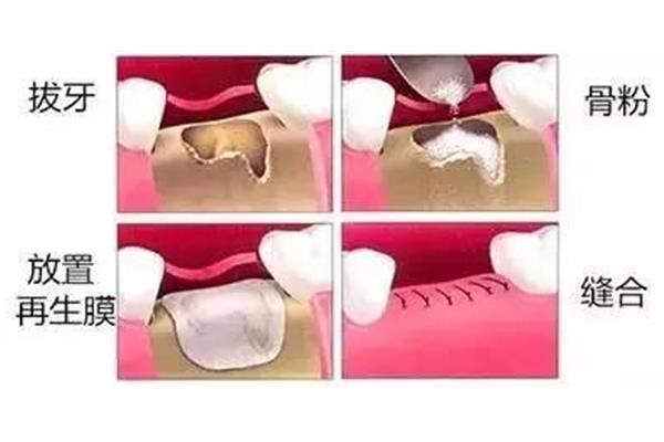 加骨粉骨膜后种牙要多久(种牙一定要植入骨粉吗)