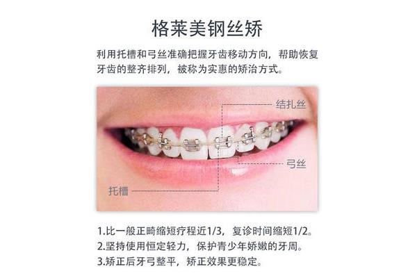 用鋼絲矯正牙齒需要多久,成年人用鋼絲矯正牙齒需要多久?