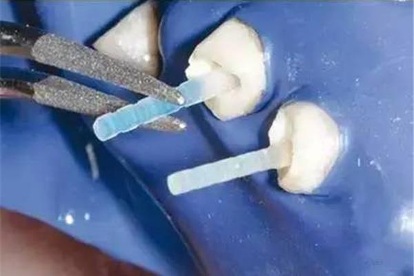 树脂纤维带可以用于松牙多久(纤维韧带固定松牙)