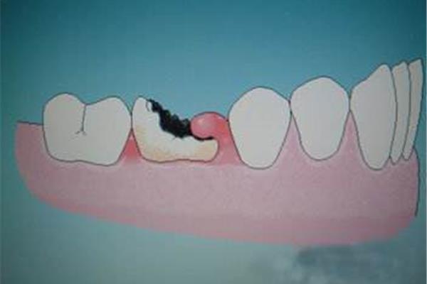 補一顆大牙能用多久