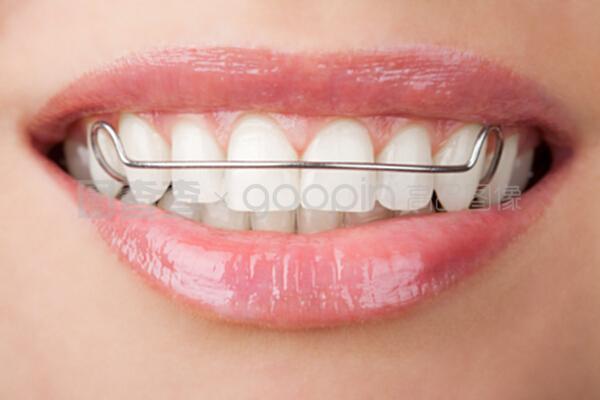 用牙套矫正牙齿需要多长时间(用牙套矫正牙齿有什么问题?)