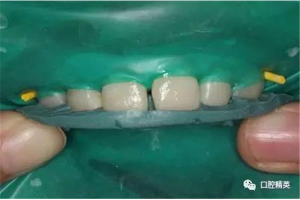 牙洞填充树脂可以用多久(牙洞填充树脂可以用多久)